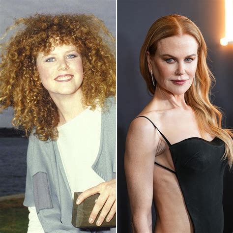 Nicole Kidman Plastic Surgery Photos Before Amp After Surgery4 Nicole Kidman Plastic Surgery Photos Before Amp After Surgery4