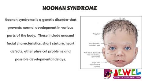 Noonan Syndrome 20 Facts You Didn Amp 39 T Know Discover Walks Blog