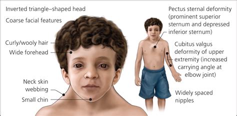 Noonan Syndrome Aafp