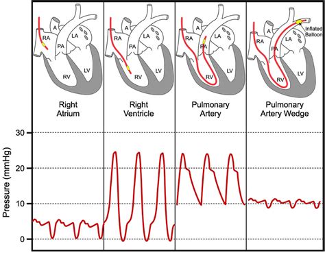 Normal Pulmonary Artery Pressure