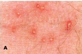 Oak Mite Bites Pictures: Identifying Symptoms and Relief Tips