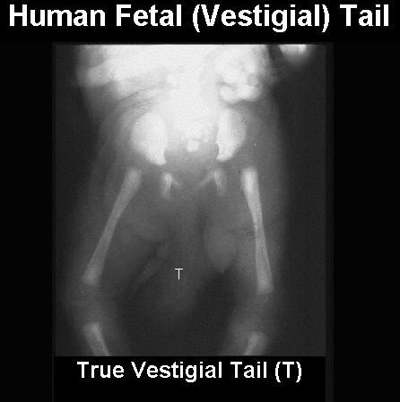 On Rare Occasions Children Can Be Born With Vestigial Tails Or Pseudotails Resulting From The Activation Of Dormant But Still Present Dna Coding For Faulty Characteristics R Interestingasfuck