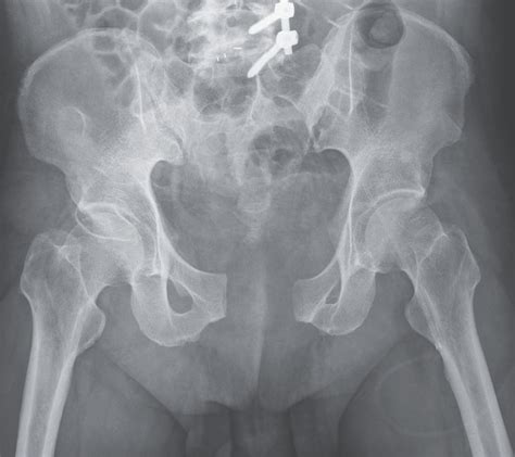 Open Book Pelvic Fracture: Causes, Treatment, and Recovery Tips