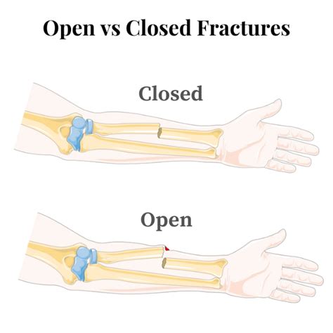 Open Fracture Vs Closed Fracture Know The Difference