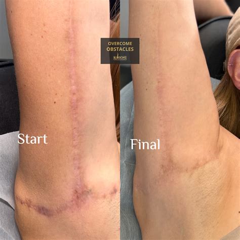 Paramedical Tattoo Scar Camouflage Paramedicaltattoodallas Paramedical Tattoo Scar Camouflage Paramedicaltattoodallas