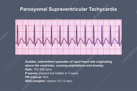 Paroxysmal Supraventricular Tachycardia Medizzy