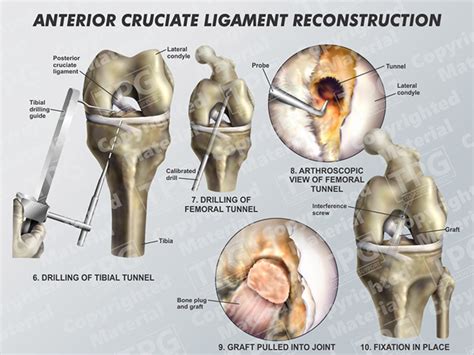 Pdf Anterior Cruciate Ligament Reconstruction Kneeclinic Com Au