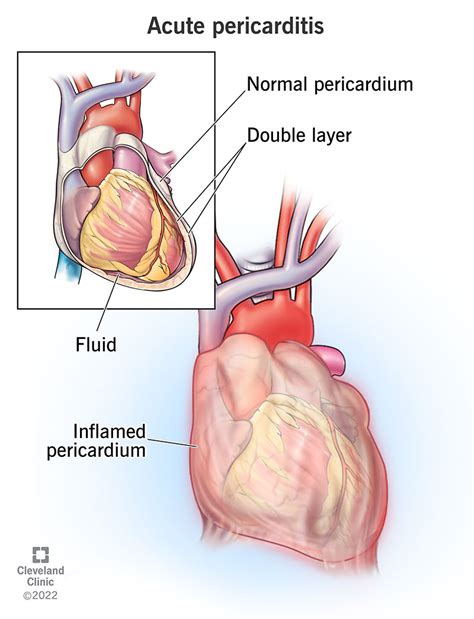 Pericarditis Medication