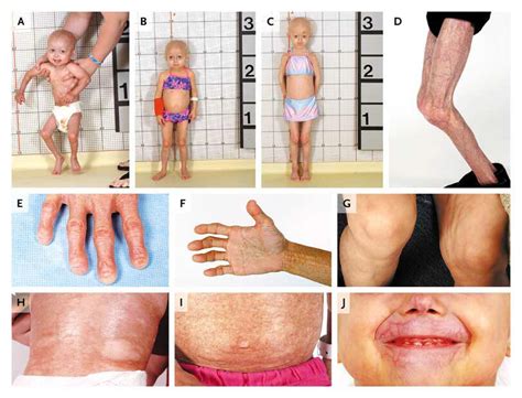 Phenotype And Course Of Hutchinson Gilford Progeria Syndrome New England Journal Of Medicine