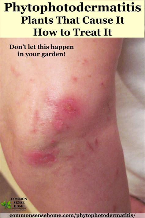 Phytophotodermatitis Plants That Cause It How To Treat It
