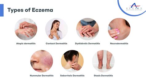 Picture Of Eczema Pictures Photos