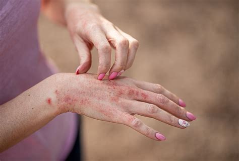 Picture Of Eczema