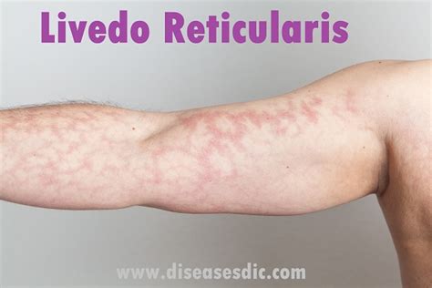 Picture Of Livedo Reticularis Livedo Reticularis Skin Diseases Picture Of Livedo Reticularis Livedo Reticularis Skin Diseases
