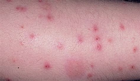 Pictures Of Flea Bites