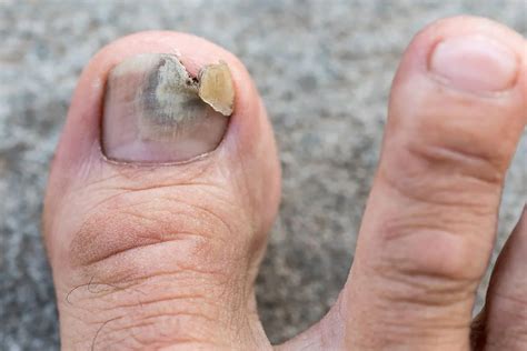 Pictures Of Toenail Fungus