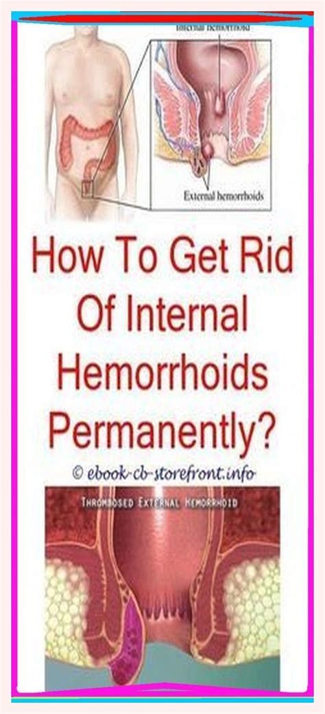 Pin On Hemorrhoids Remedie