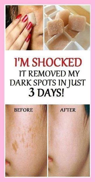 Pin On Natural Skin Lightening Dark Spots Pin On Natural Skin Lightening Dark Spots