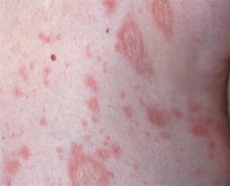 Pityriasis Rosea Pictures
