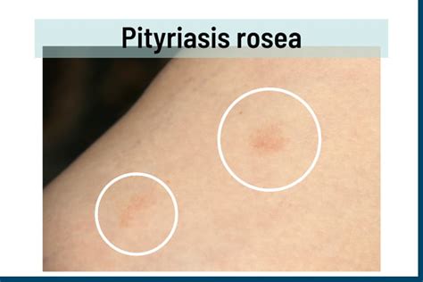 Pityriasis Rosea Vs Ringworm