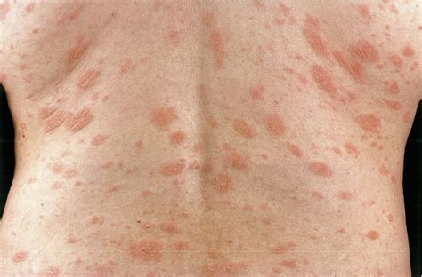 Pityriasis Rosea