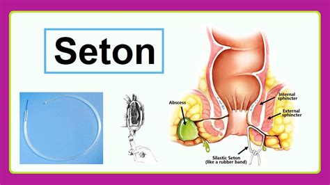 5 Tips Seton Placement