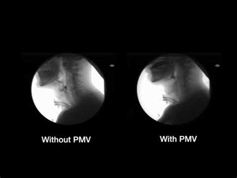 Pmv Medical Abbreviation
