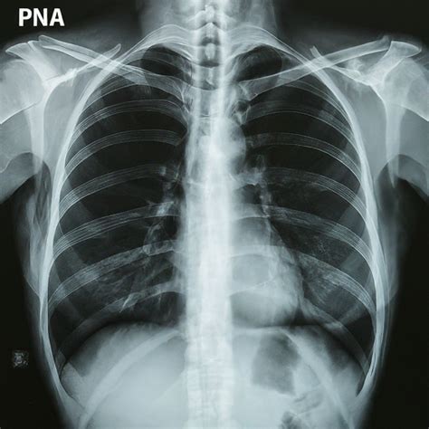 Pna Medical Abbreviation