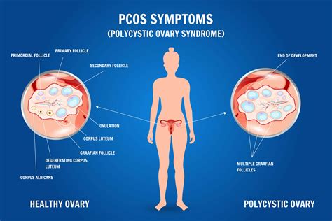 Polycystic Ovarian Syndrome Fqn0009 Polycystic Polycystic Ovarian Syndrome Fqn0009 Polycystic