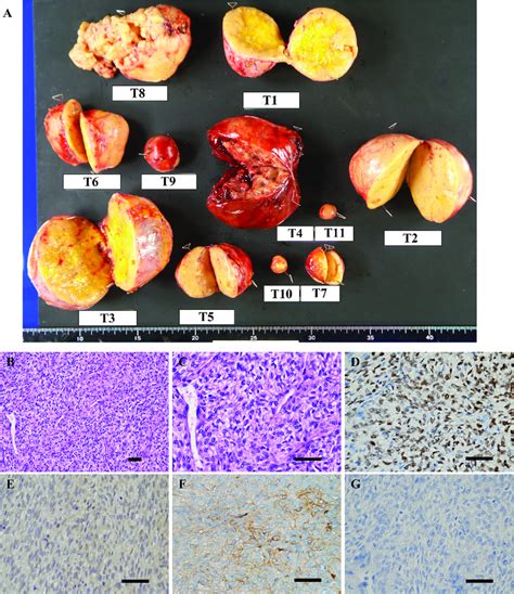 Postoperative Image Of The Resected Tumor Demonstrating Its Contents Download Scientific Diagram