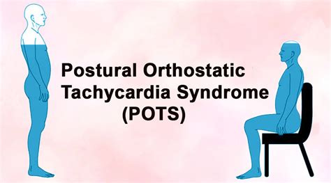 Postural Orthostatic Tachycardia Syndrome Pots Sujata Birla Hospital