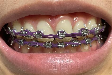 Power Chain Braces Can Help To Close Large Gaps Between Your Teeth They Use Extra Pressure To Get To You Closer To Your Goal Smile In Less Time Power Chains Are An