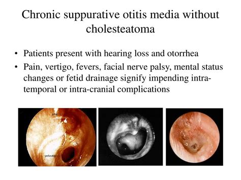 Ppt Chronic Otitis Media Com With And Without Cholesteatoma