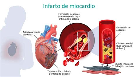 Prevenci N Del Infarto Agudo De Miocardio Prevenci N Del Infarto Agudo De Miocardio