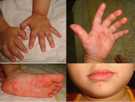 Prevent Your Kiddos From Spreading Hand Foot Mouth Disease Prevent Your Kiddos From Spreading Hand Foot Mouth Disease