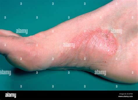 Psoriasis On Feet Images