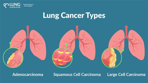 Pulmonary Artery Reconstruction For Non Small Cell Lung Cancer Pulmonary Artery Reconstruction For Non Small Cell Lung Cancer