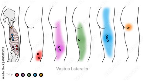 Quadriceps Vastus Lateralis Myofascial Trigger Points And Associated