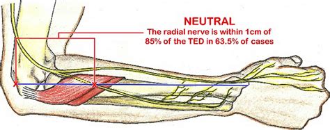 Radial Tunnel Syndrome Causes Symptoms Diagnosis Treatment