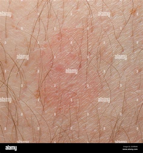 Rash Hi Res Stock Photography And Images Alamy