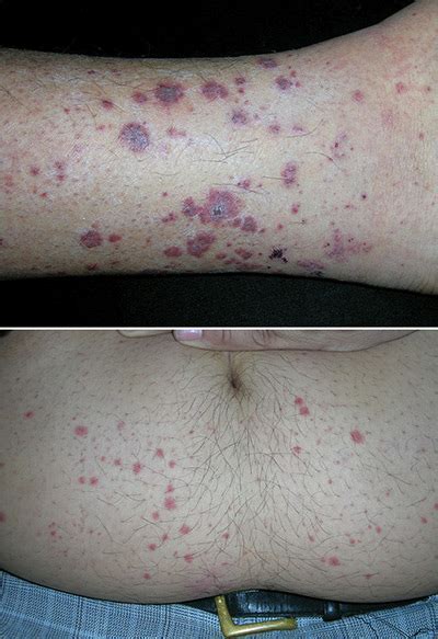Rash On Lower Legs And Abdomen Mdedge Family Medicine Rash On Lower Legs And Abdomen Mdedge Family Medicine