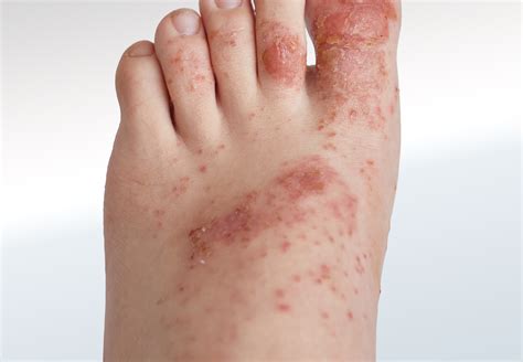 Rash On Top Of Foot