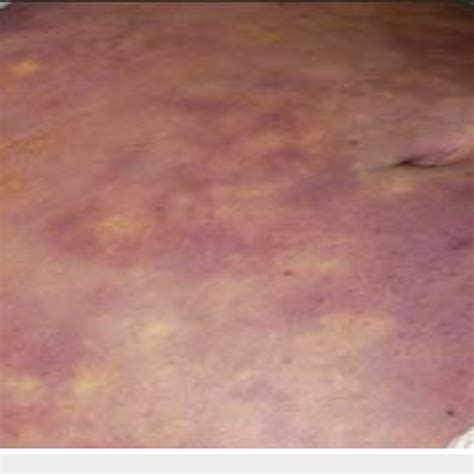 Rashes On Patient S Abdomen Download Scientific Diagram Rashes On Patient S Abdomen Download Scientific Diagram