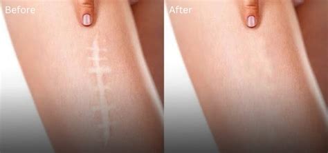 Reclaim Your Skin The Ultimate Guide To Scar Camouflage Tattoos Reclaim Your Skin The Ultimate Guide To Scar Camouflage Tattoos