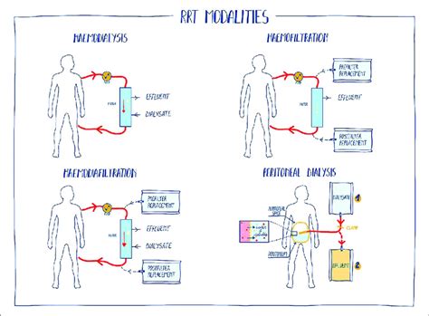 Renal Replacement Therapy Rrt Modalities In Acute Heart Failure
