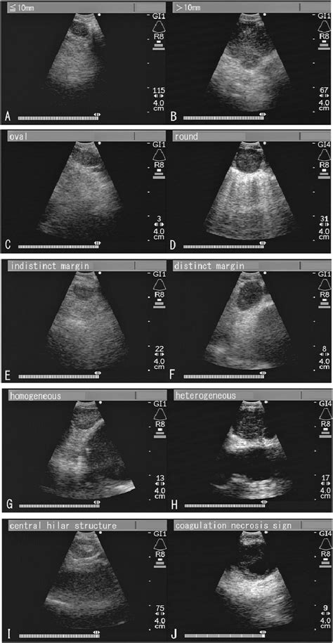 Representative Morphologic Fi Ndings Of Ebus Characteristics Size 1 Cm Download Scientific Diagram