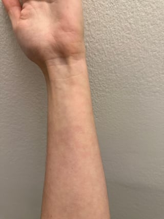 Ringworm Pityriasis Rosea Or Something Else R Dermatologyquestions