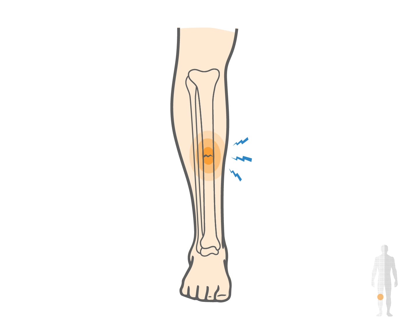 Running Stress Fracture Shin Symptoms Running Stress Fracture Shin Symptoms