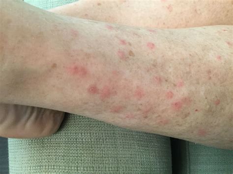 Sand Flea Bites Pics