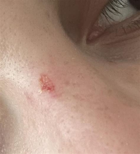 Scab In Nose