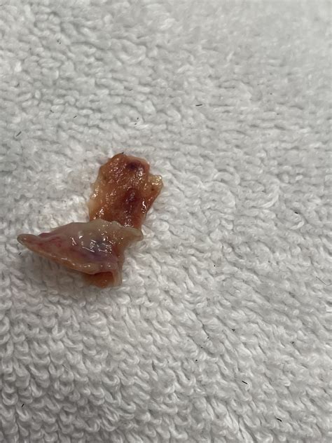 Scab Like Boogers In Nose